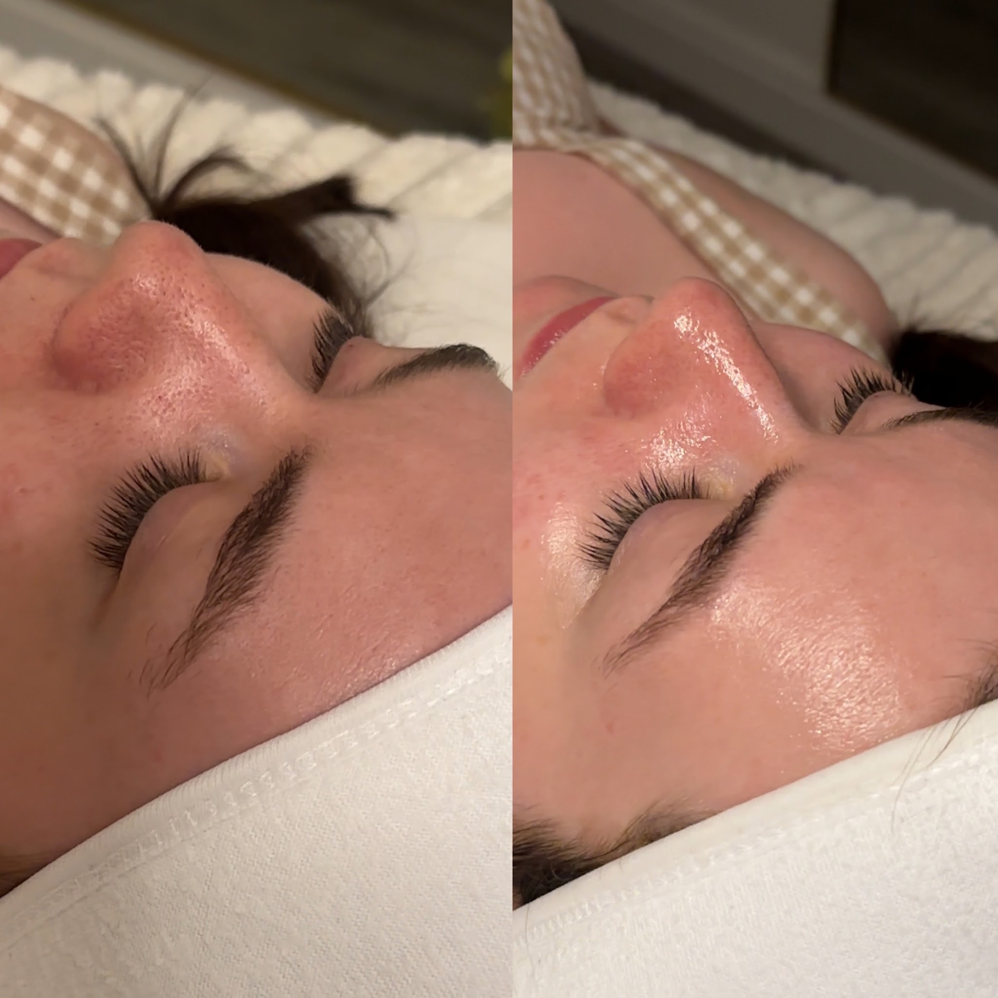 Before and after a facial, a client's cheek side by side