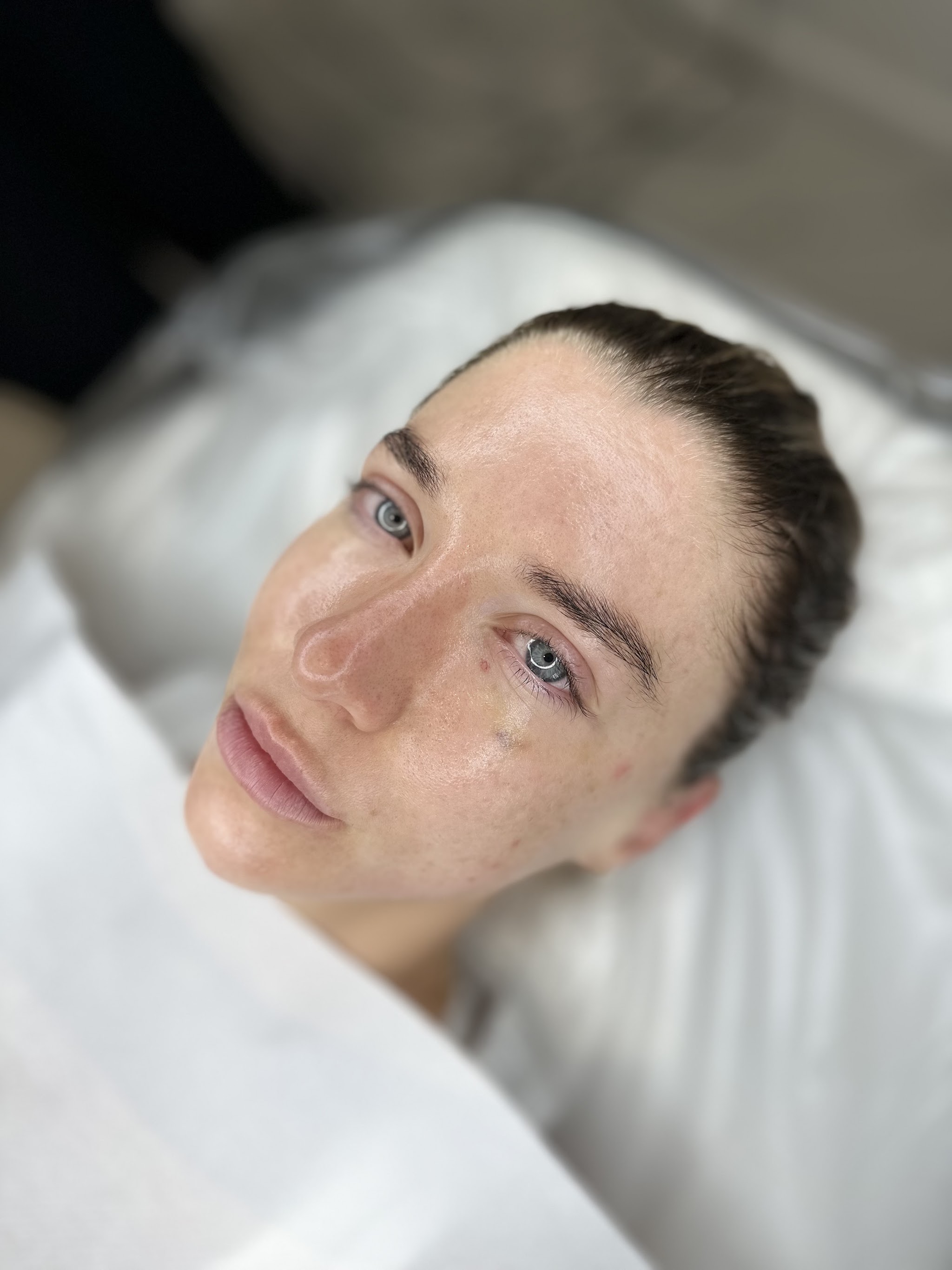 A client with fresh, clear skin after her treatment