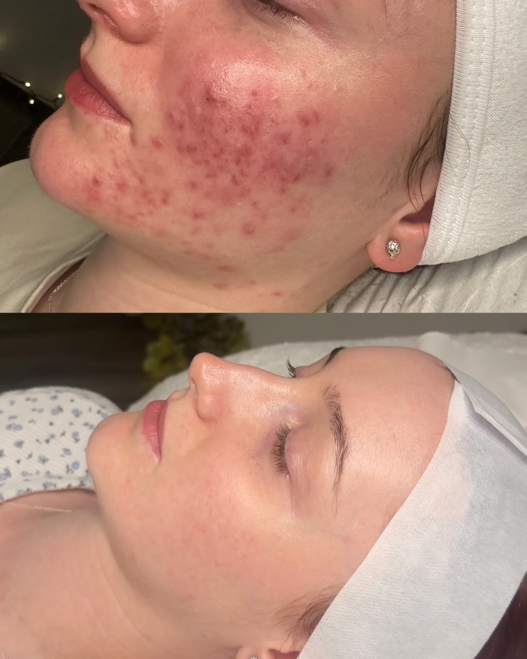 Before and after acne treatment, breakouts cleared