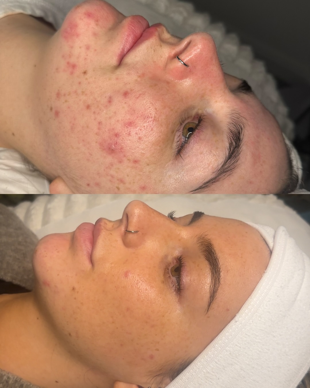 Before and after a course of acne treatment